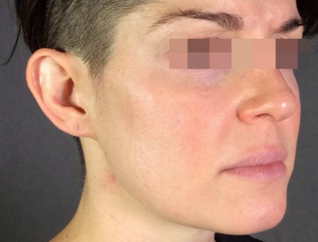 After three RF microneedling sessions: cheek appears calmer with smoother texture