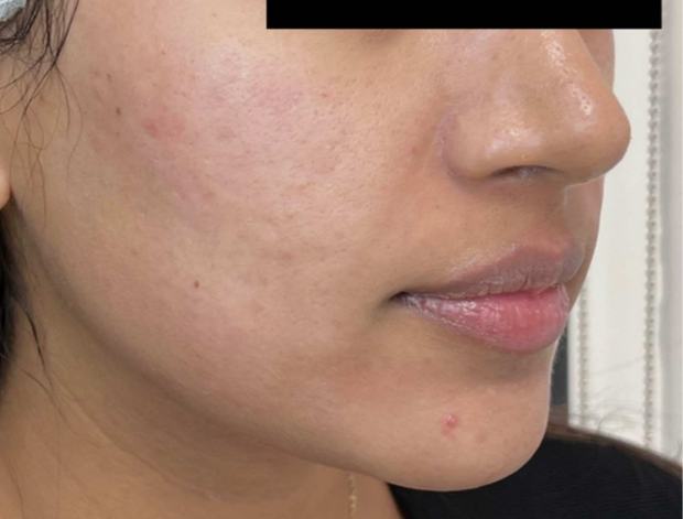 Six weeks after two RF microneedling sessions: cheek looks more even in tone and texture