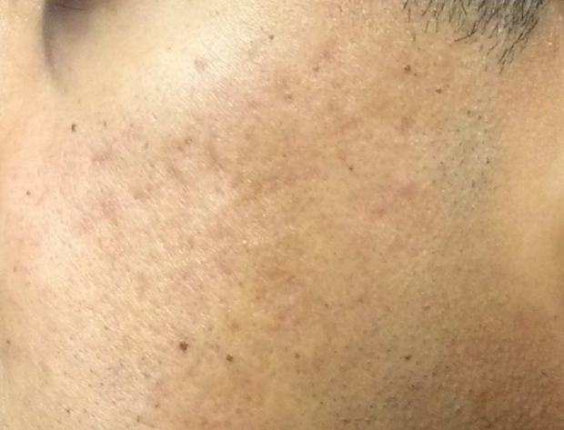After a single RF microneedling session: cheek scarring appears softened and flatter