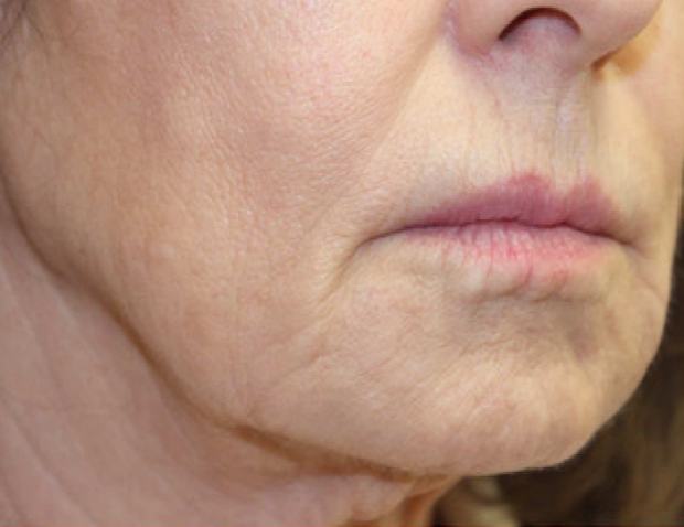 After two RF microneedling sessions: perioral lines appear softened and the jawline smoother
