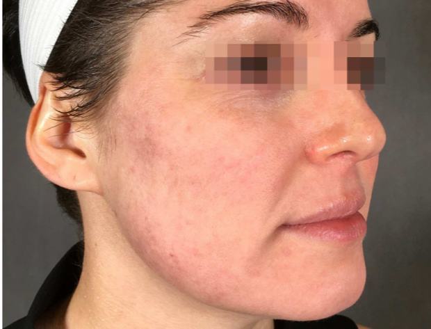Before RF microneedling: cheek with acne scarring, redness and uneven texture
