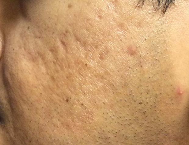 Before RF microneedling: close-up of cheek with raised and pitted acne scarring