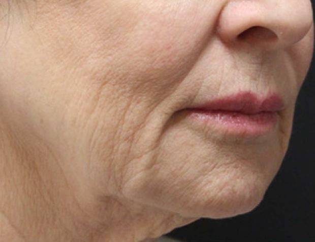 Before RF microneedling: lower face with deep perioral lines and jawline laxity