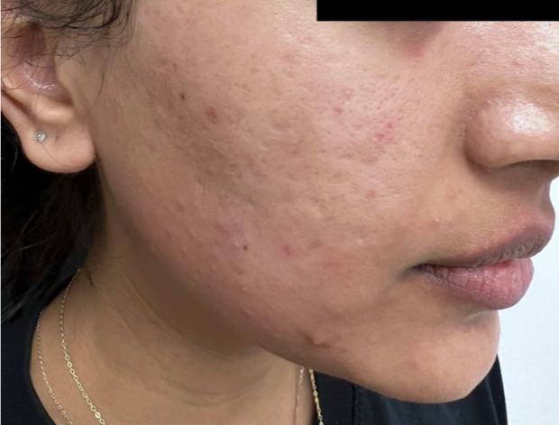 Before RF microneedling: cheek and jawline with acne scarring and post-inflammatory marks